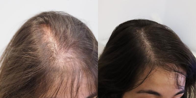 Recupera tu cabello con un implante capilar